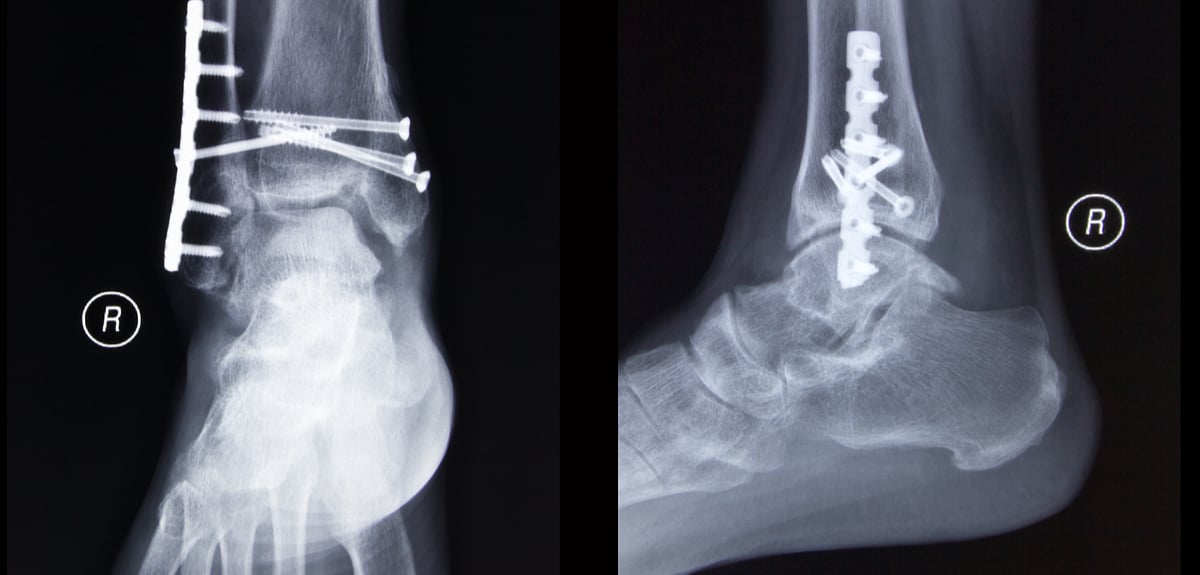 Elderly patients with unstable ankle fractures could avoid